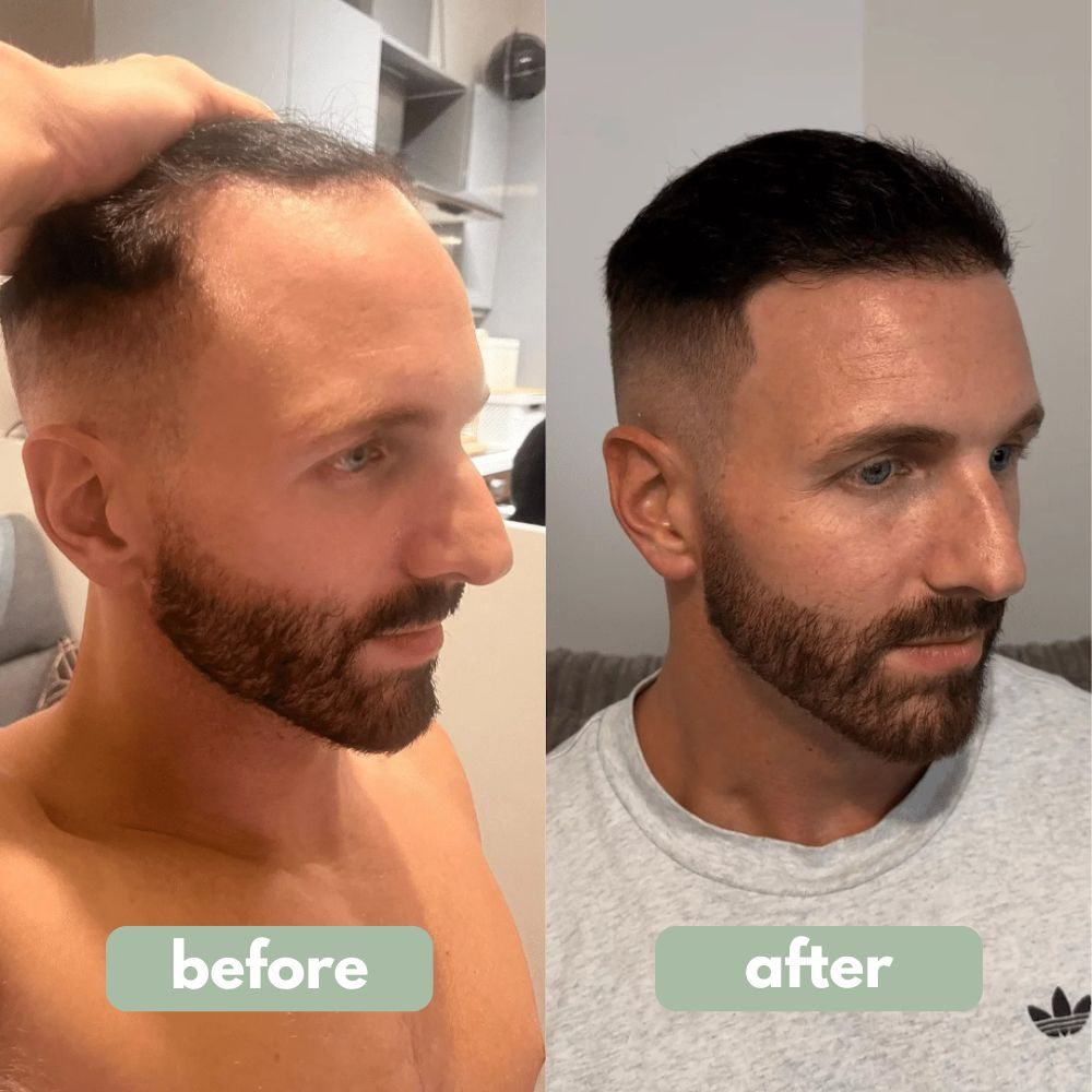 ✨Hair Growth Serum Roll-On (New Formula)🎁